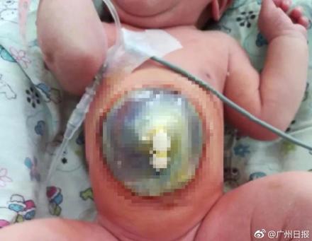 女婴出生时肝脏肠管裸露，医生妙手“归位”扭转命运