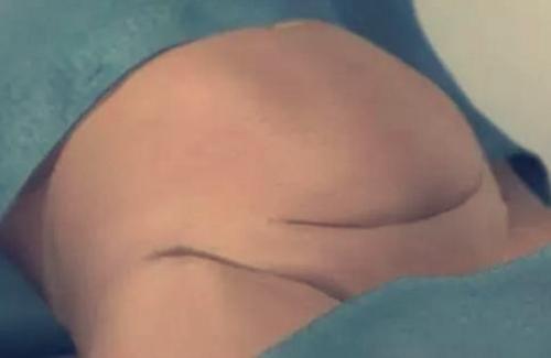 七张图详解剖腹产手术全过程,女人有多伟大,每个男人都该看看