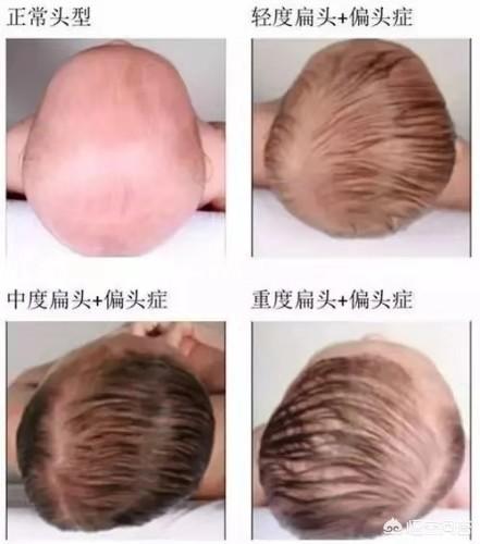 宝宝的头多久就定型了？