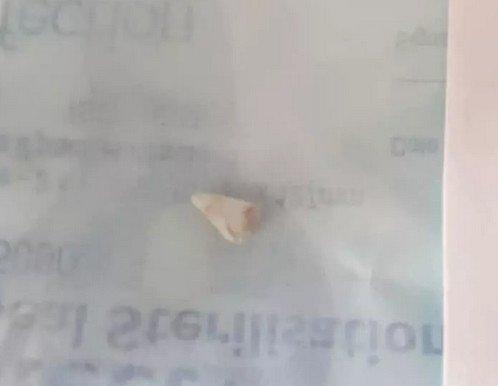 变异？婴儿一夜长出“尖牙”，医生束手无策，到底是牙还是病？