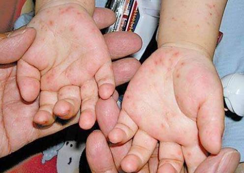 秋冬也是宝宝“手足口病”的高发期，做好预防工作，家长别懈怠