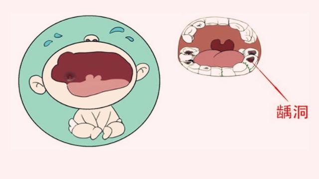宝宝常刷牙为何还有蛀牙？这2大致病因素不可忽略，你做到了吗