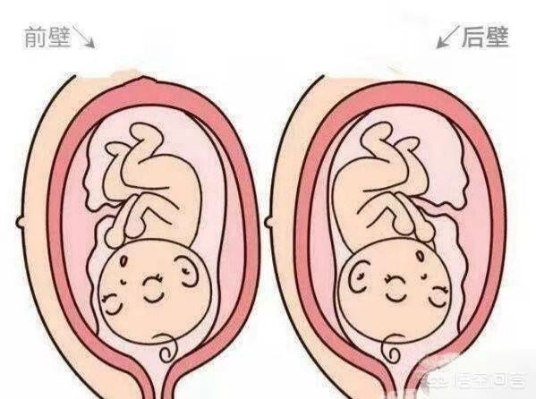 怀孕胎儿位置在前壁后壁有什么不同吗？
