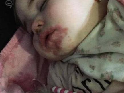 10个月宝宝患手足口却排队20小时才就诊 英国医院遭宝妈投诉