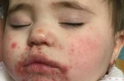 10个月宝宝患手足口却排队20小时才就诊 英国医院遭宝妈投诉