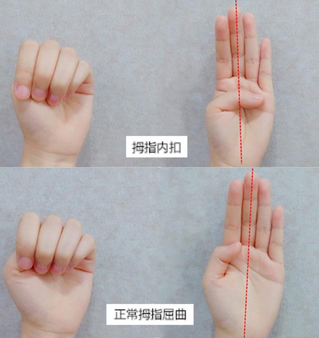 握拳拇指弯曲就是拇指内扣？答案和你想的不一样，家长别再焦虑了