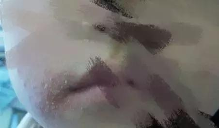 宝宝烂口角就是上火？你是不是对上火有什么误解？