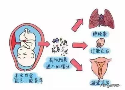 羊水栓塞如“产科死神”，这五类孕妇要警惕！