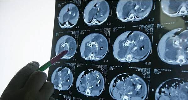 某地发现罕见双胞“寄生胎”，宝宝“躲进”姐姐的肚子里