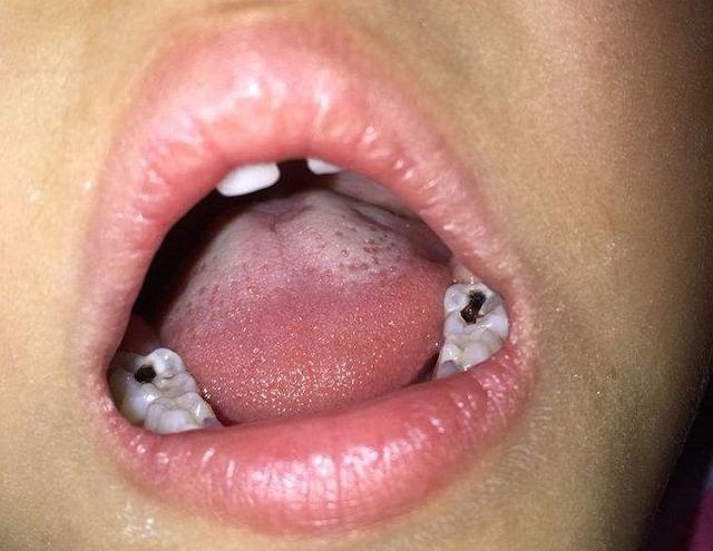 孩子睡觉磨牙，是因为肚子里有蛔虫？看看事情的真相是什么吧！