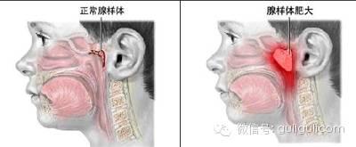 孩子反复鼻塞流涕 当心腺样体肥大！