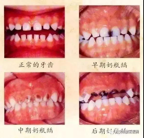 孩子门牙发黑，家长须重视