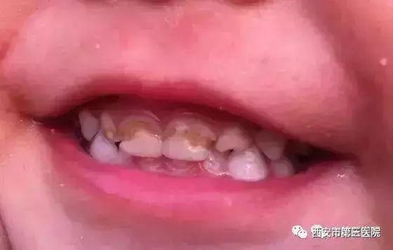 孩子门牙发黑，家长须重视