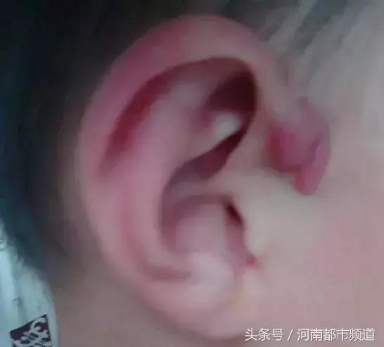 8个月男婴耳旁长“聪明孔”，挤出的白浓发臭，医生：别乱碰！