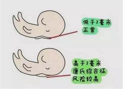 产检如果出现这几种特征，说明胎儿很可能智力有问题