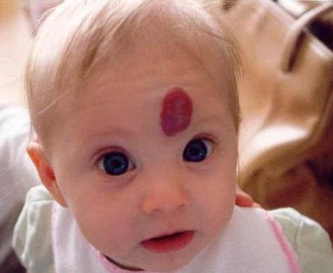 怎么预防儿童有胎记?儿科医生告诉你