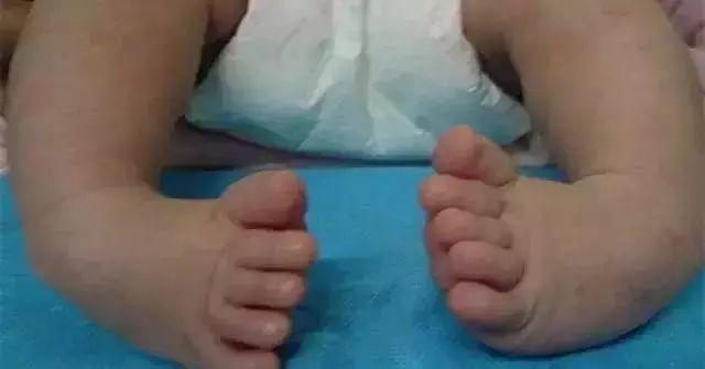 2岁宝宝双足畸形，只因妈妈做了这事！