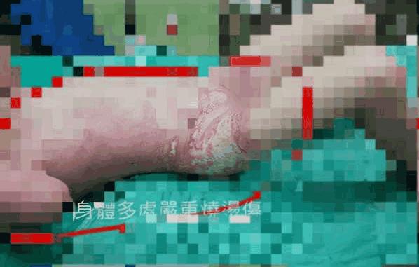 5岁女童幼儿园被烫伤，血肉模糊，老师却粗暴将其拽出教室