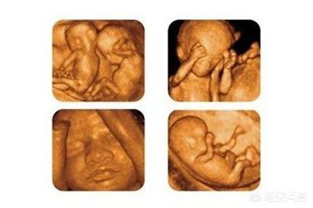 孕期需要去做几次四维？要注意什么？