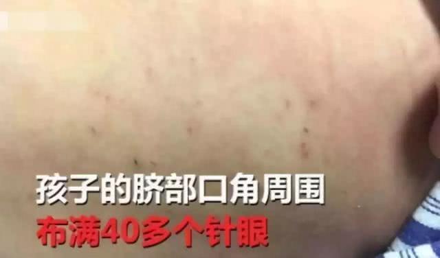 闹夜,湖北爸妈针扎肚子致宝宝进ICU,“过来人”经验变教训!