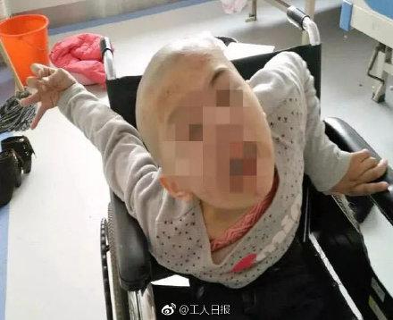 女童误喝妈妈泡的山豆根茶 致手脚变形严重脑损伤