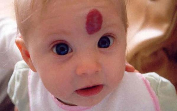 什么是血管瘤?宝宝有血管瘤该怎么治疗呢?