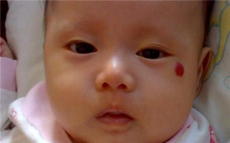 什么是血管瘤?宝宝有血管瘤该怎么治疗呢?