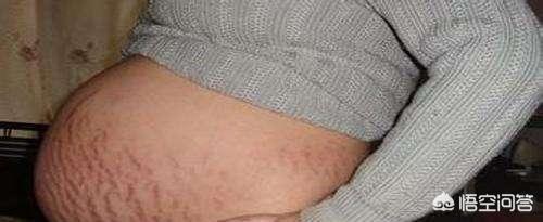 宝妈们是怀孕几个月时开始长妊娠纹的？