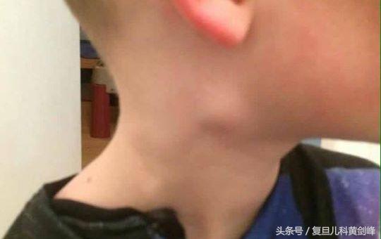 宝宝脖子上摸到个小疙瘩要紧哇？
