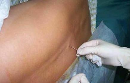 剖宫麻醉令妻儿变傻？医生有话要说