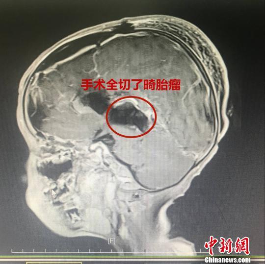 5岁男童脑里长头发 原是生出“畸胎瘤”