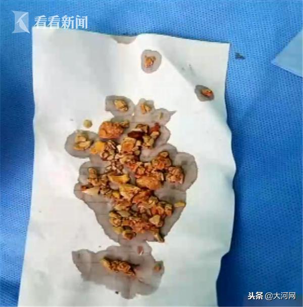 出生3天就喂辅食！5个月大婴儿双肾长满结石 全身浮肿险丧命