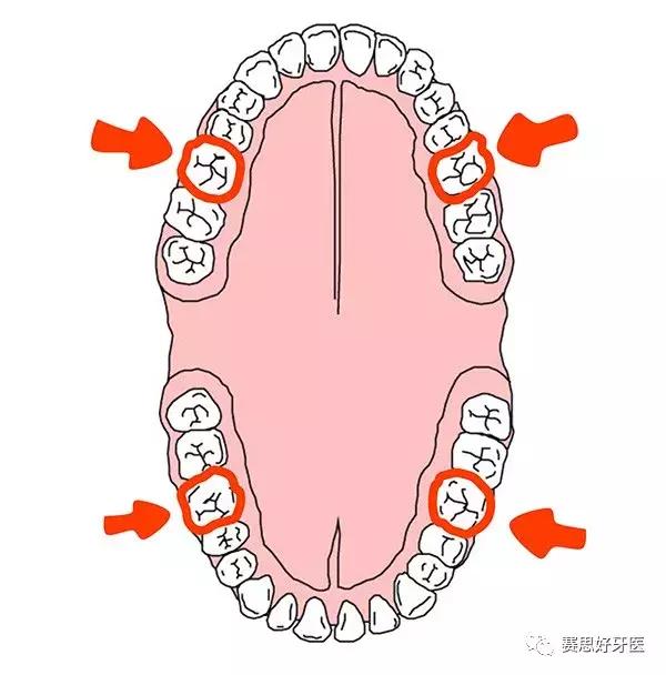 窝沟封闭，给孩子们的牙齿披上“铠甲”！
