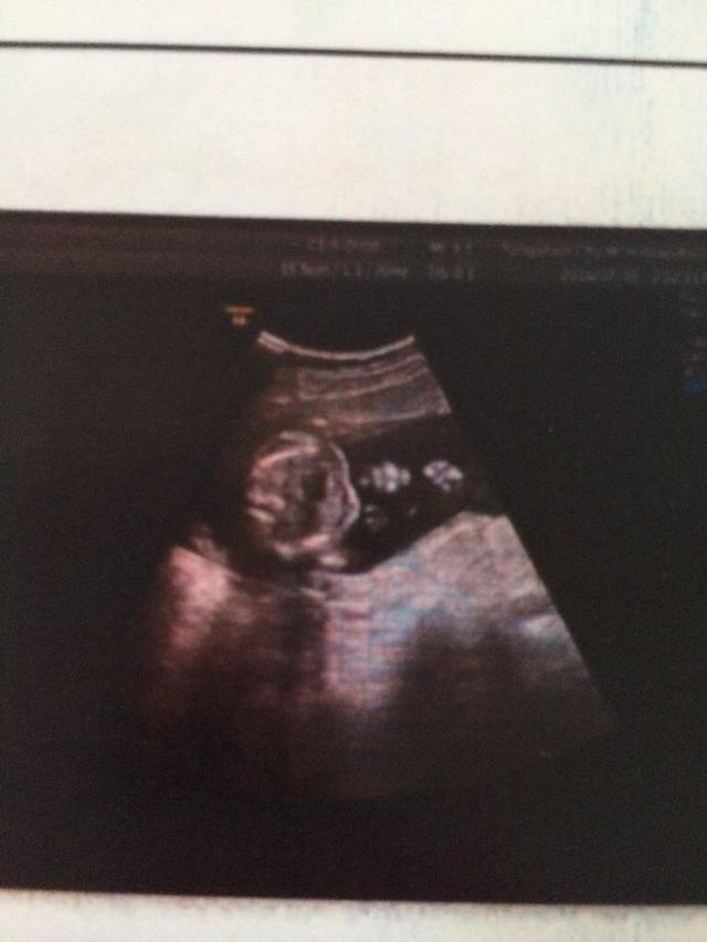 怀孕18周的胎儿是什么样子的？很多准妈妈还不清楚，早知道好一些