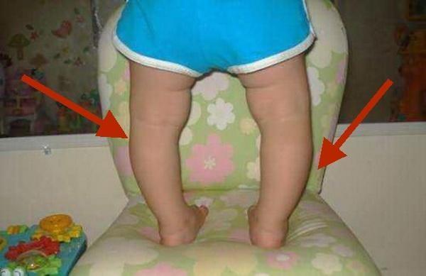 孩子长成O型腿怪孕妇？不，娘胎不背锅，这3点才是病因