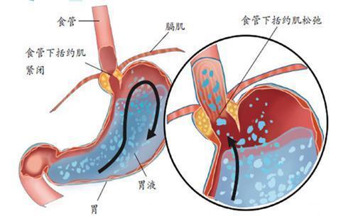 新生儿“呛奶急救口诀”, 家长一定牢记于心！