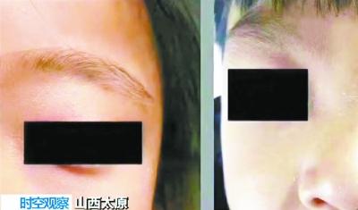 粗心！教师误开紫外线灯 32名幼儿灼伤