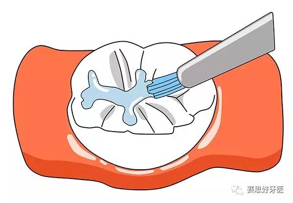 窝沟封闭，给孩子们的牙齿披上“铠甲”！