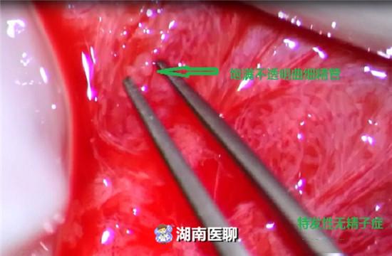 生育几率几乎为零？无精子症男子喜极而泣，显微取精为他圆育儿梦