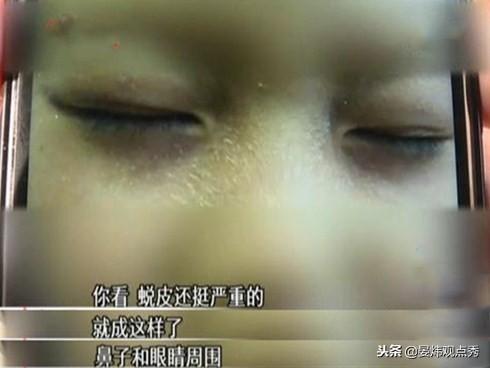 痛心！幼师误开紫外线灯 多名幼儿眼部被灼伤