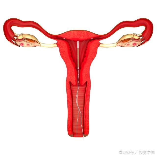 取下“节育环”后，多久能怀孕？备孕二胎的夫妻，看完就知道了！