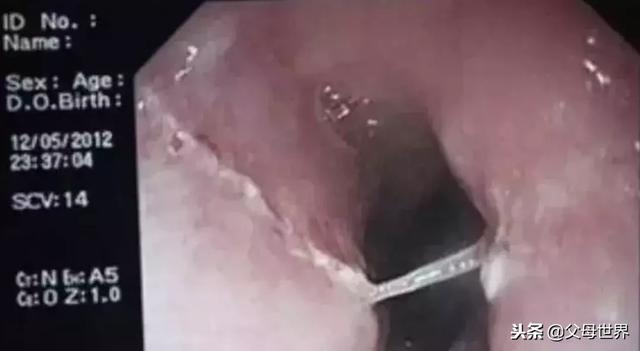 鱼刺卡到喉咙！这才是正确的急救方法，建议收藏！