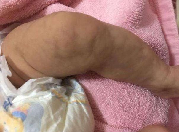 宝妈给宝宝洗澡时发现孩子腿不对劲，医生说幸好来得早