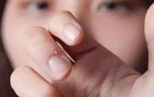 为啥指甲周围会长倒刺？是缺维生素？撕之前先看这些