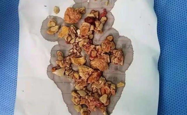 错误喂养至5个月女婴患肾结石，辅食喂不对，宝宝受苦啊