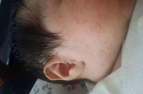 宝宝湿疹反反复复总不好?当心是爸妈犯了这些错!