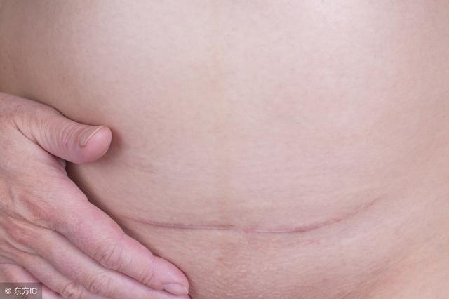 剖腹产后，伤口该如何护理？