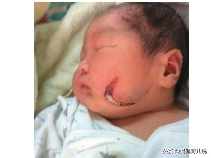 顺产用产钳就等于保大人？看看被产钳夹出的新生儿有多“惨”吧！