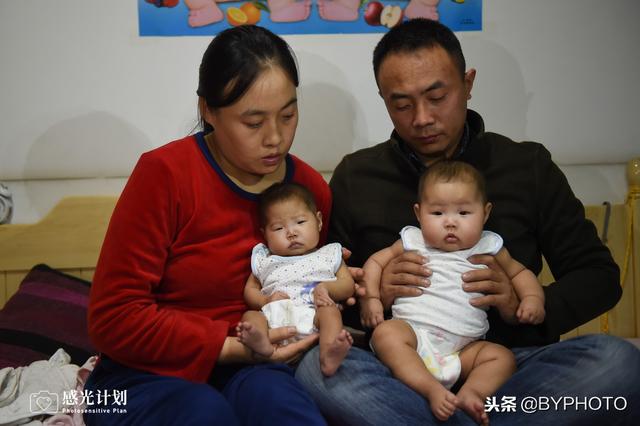 同胎不同命，妹妹仨月开两刀，与姐姐再见时已不像双胞胎