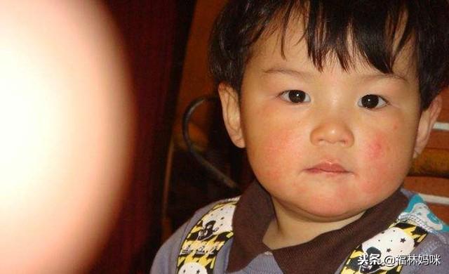 冬天不注意宝宝皮肤的这3种情况,宝宝就要变丑啦!宝妈快看看吧